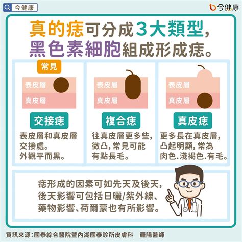 身體的痣|痣是什麼？一次了解痣原因、就醫時機以及如何改善